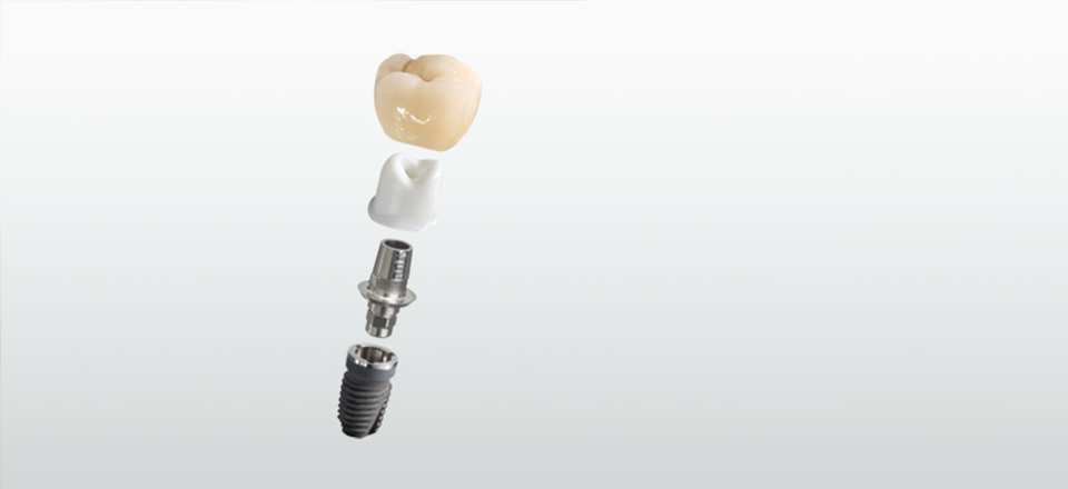 Dentale Implantologie